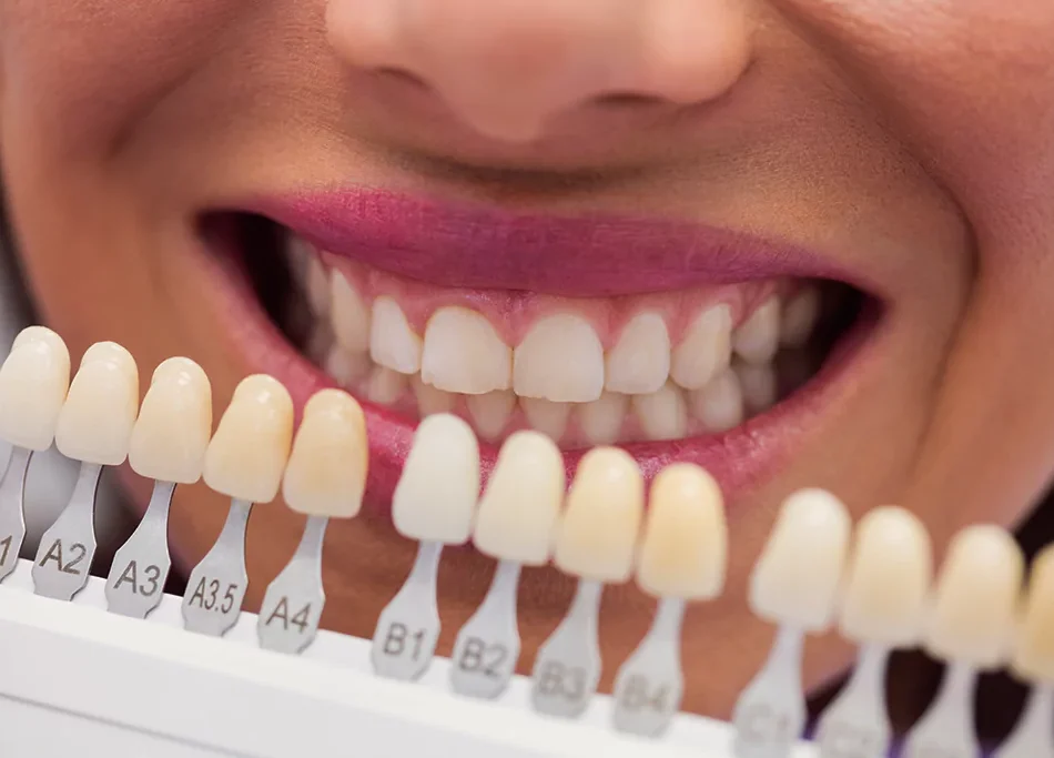 Tooth Whitening in Costa Rica