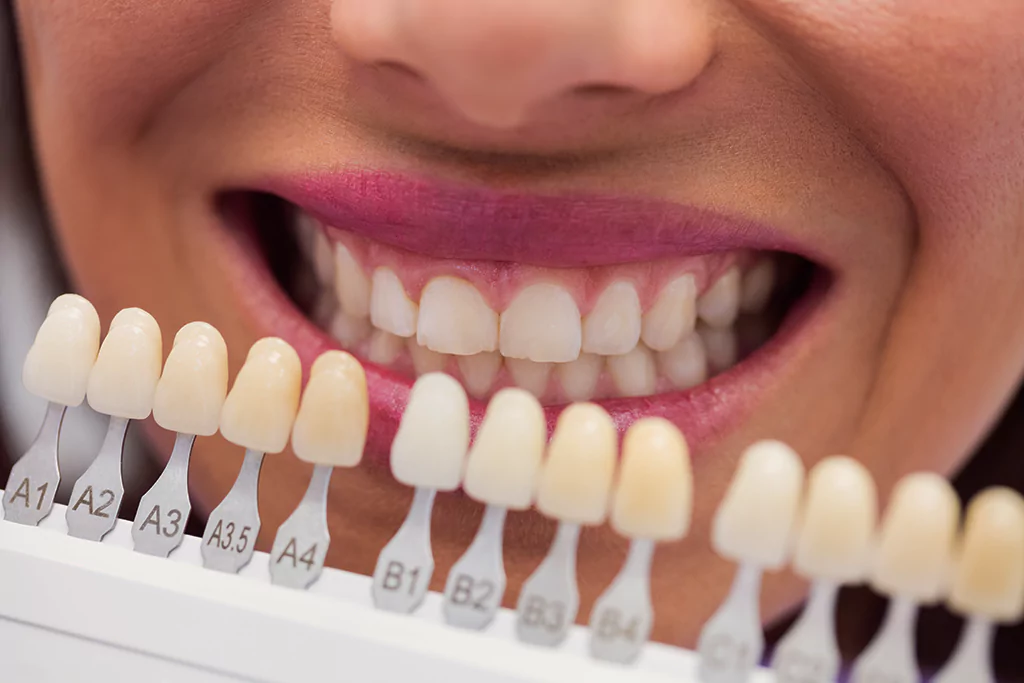 Tooth Whitening in Costa Rica